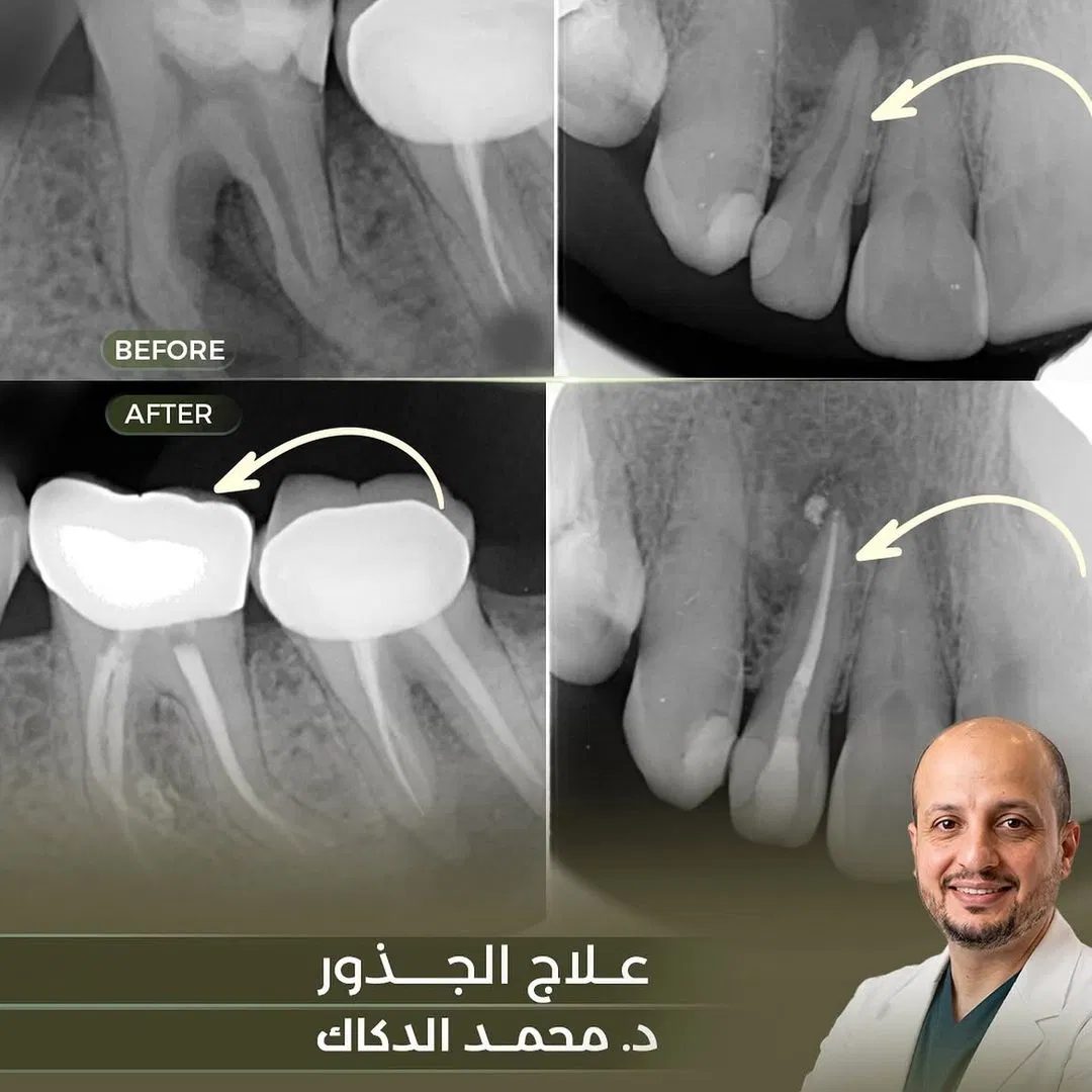 Periapical Micro-Surgery Before and After