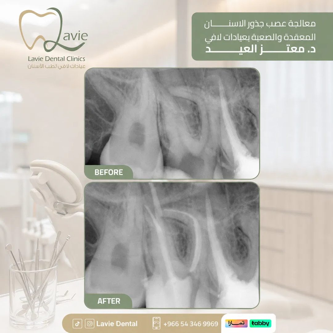 Endodontic Root Canal Therapy Before and After