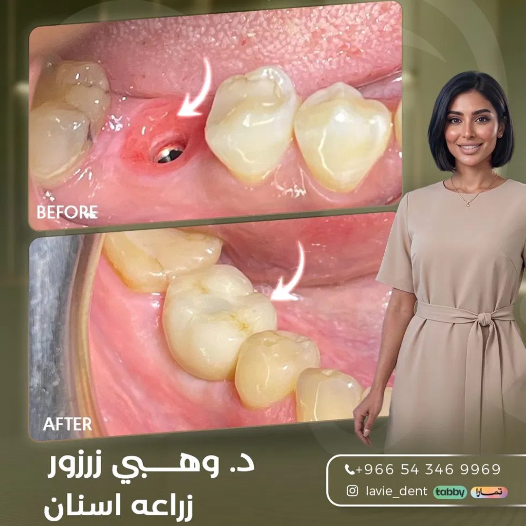 Dental Implant Before and After Transformation