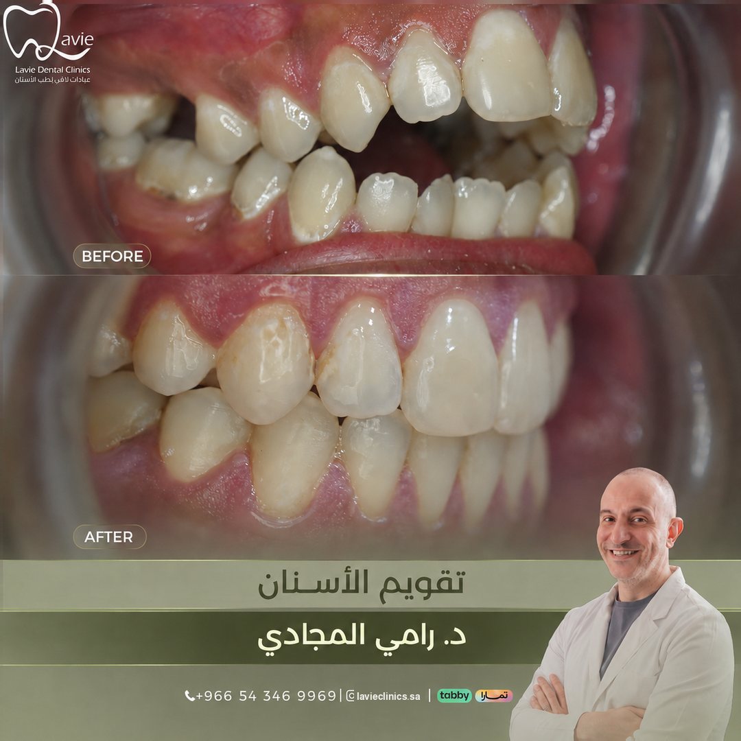 Orthodontics Alignment Before and After
