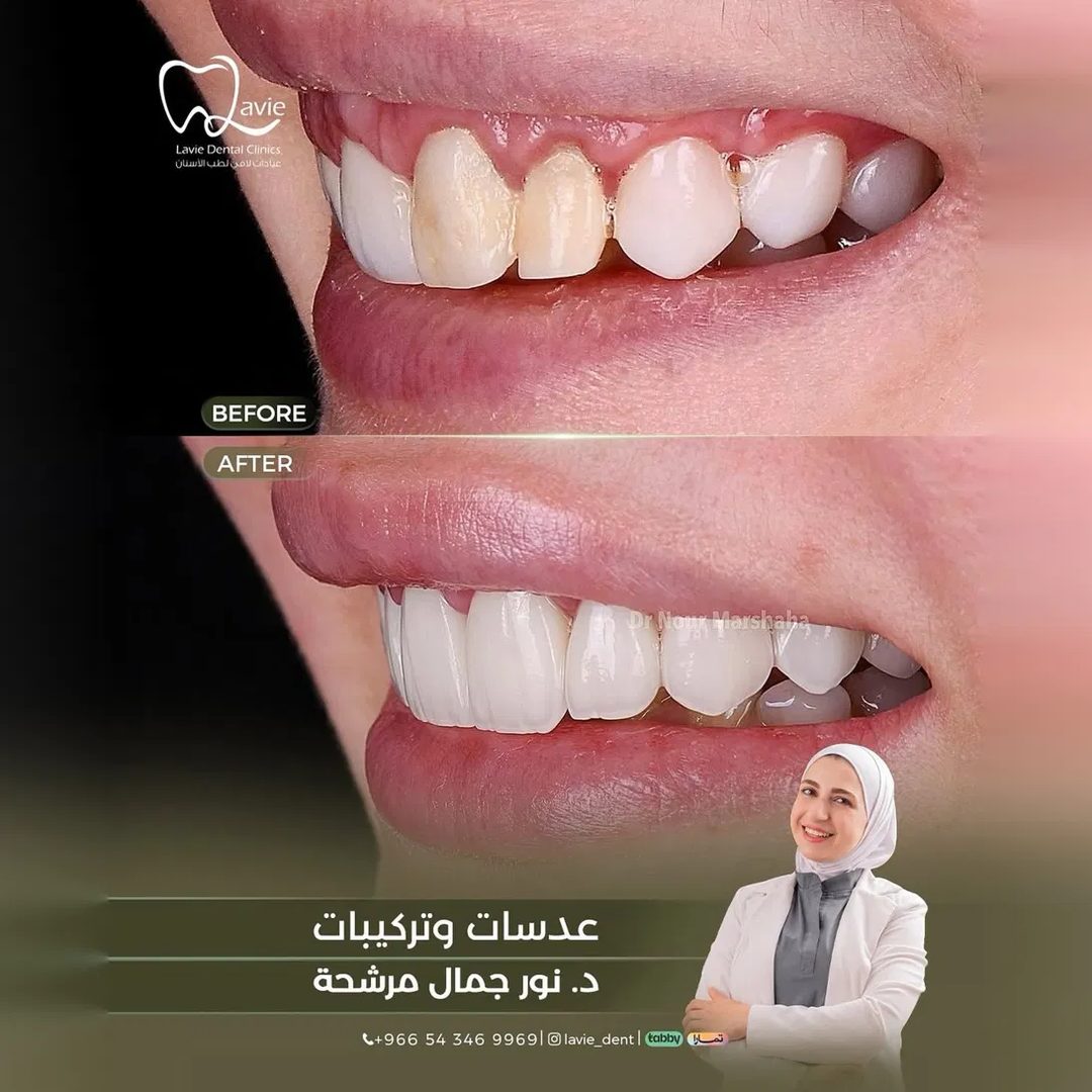 Porcelain Veneers Before and After Makeover